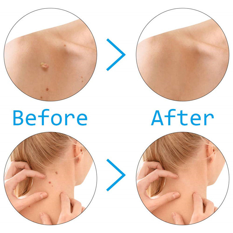 Auto Skin Tag Remover - Getitt