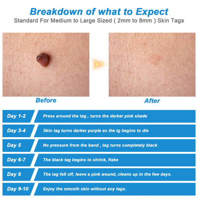 Auto Skin Tag Remover - Getitt