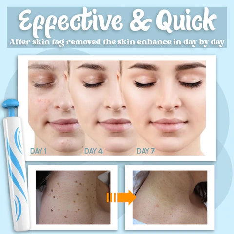 Auto Skin Tag Remover - Getitt