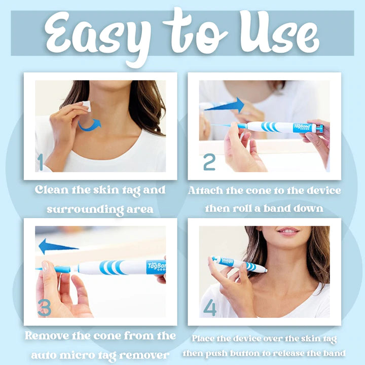 Auto Skin Tag Remover - Getitt